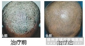 牛皮癣