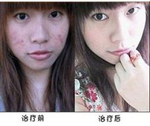 青春痘治疗前后对比图