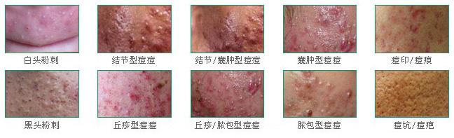 青春痘症状