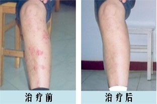 海口治疗牛皮癣前后对比图