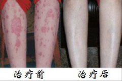 牛皮癣治疗前后