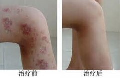 皮炎治疗前后