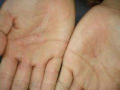 湿疹症状表现图