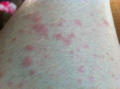 湿疹症状