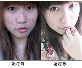 青春痘治疗