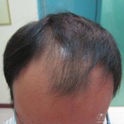 脱发患者的表现症状