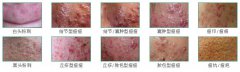 青春痘的表现症状