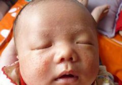 婴儿湿疹怎么护理