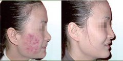 汉方光子清痘平衡中西医结合特色诊疗