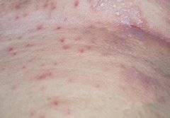干燥型湿疹是什么鬼