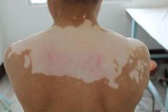 白癜风患者