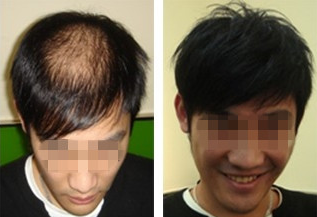 我院治疗斑秃效果对比图