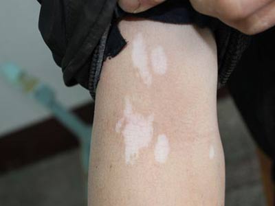 女性白癜风发病原因?