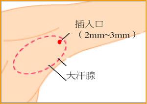 是什么缘故导致腋臭的出现的