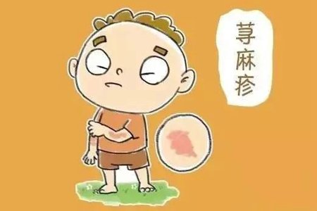 荨麻疹的生病原因关键有什么