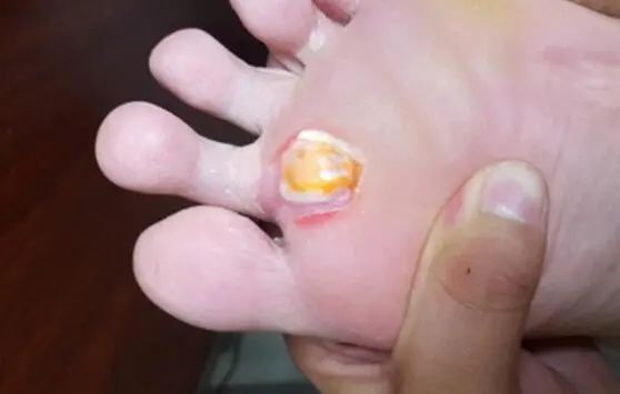 海口市哪里治鸡眼